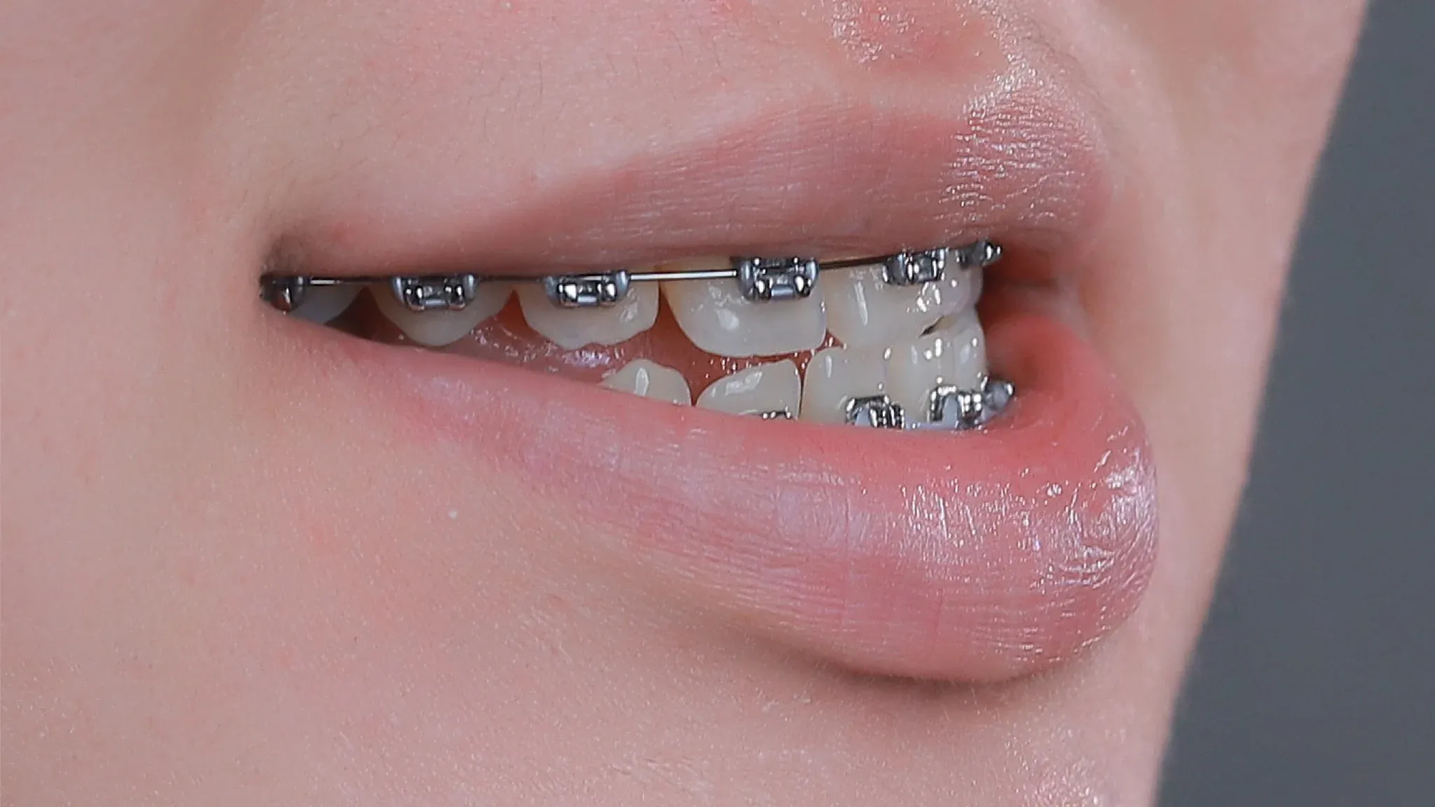 niềng răng 10 triệu