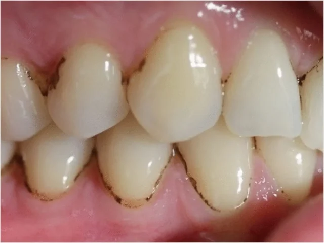 các mảng bám đen trên răng