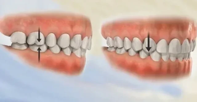 khớp cắn hạng 1