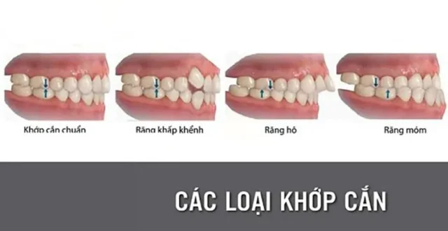 lệch khớp cắn