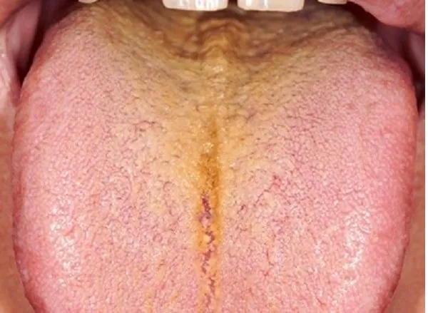 lưỡi có mảng bám màu vàng