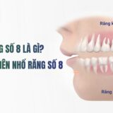 răng số 8 có nên nhổ không