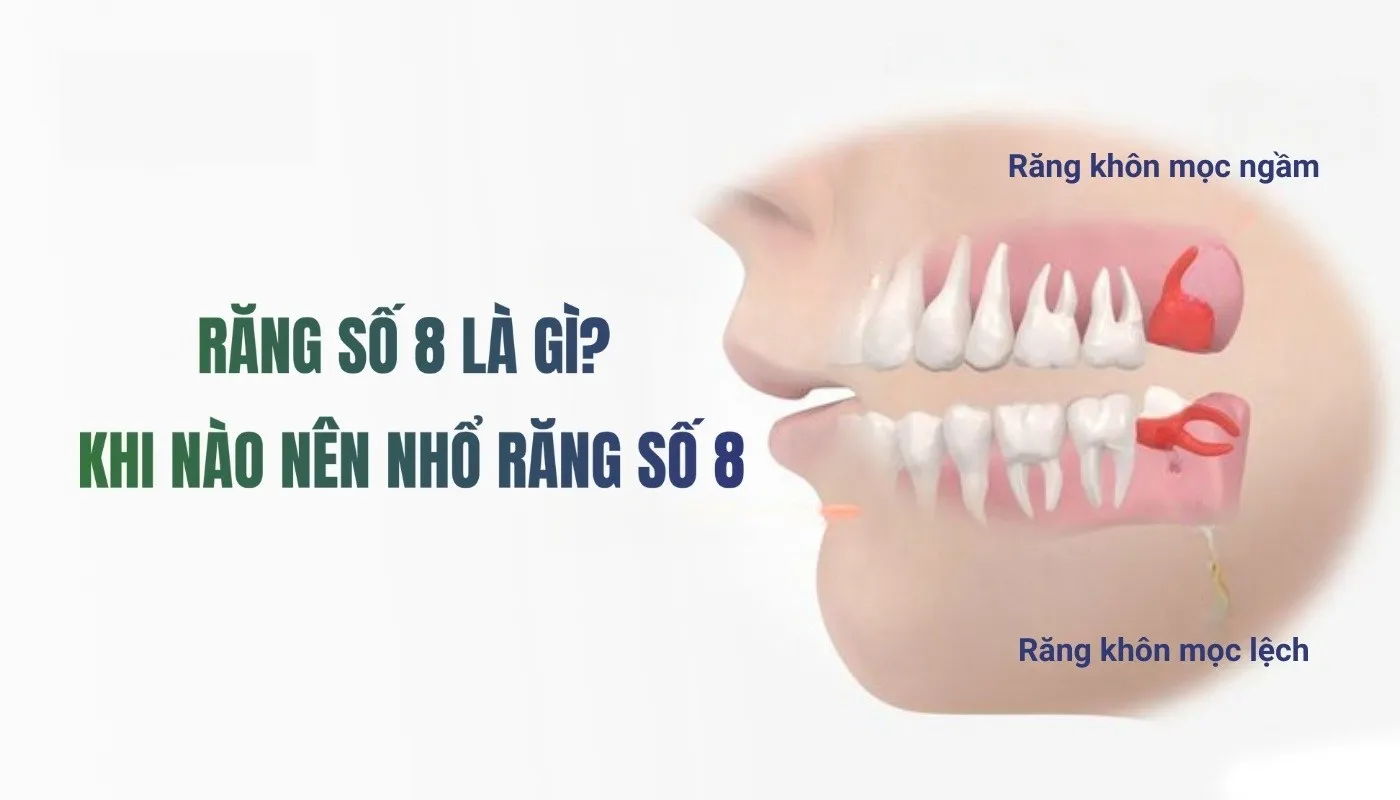 răng số 8 có nên nhổ không