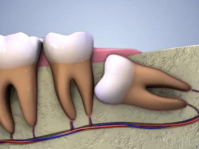 răng số 8 mọc lệch