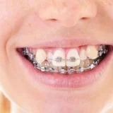các trường hợp niềng răng
