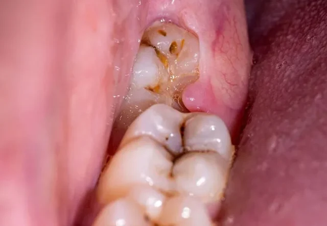 cách chữa đau răng số 8