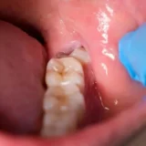 các trường hợp răng khôn mọc lệch