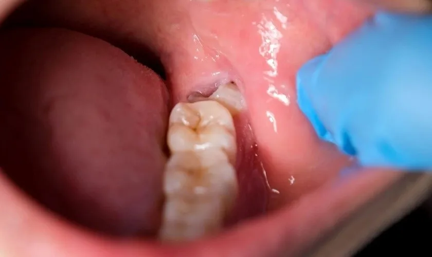 các trường hợp răng khôn mọc lệch