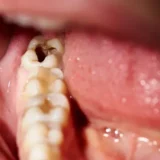 bị sâu răng có nên nhổ không