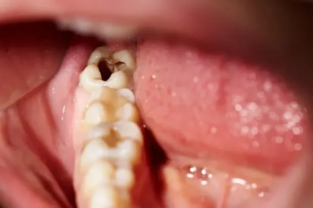 bị sâu răng có nên nhổ không