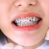 khuyến mãi niềng răng