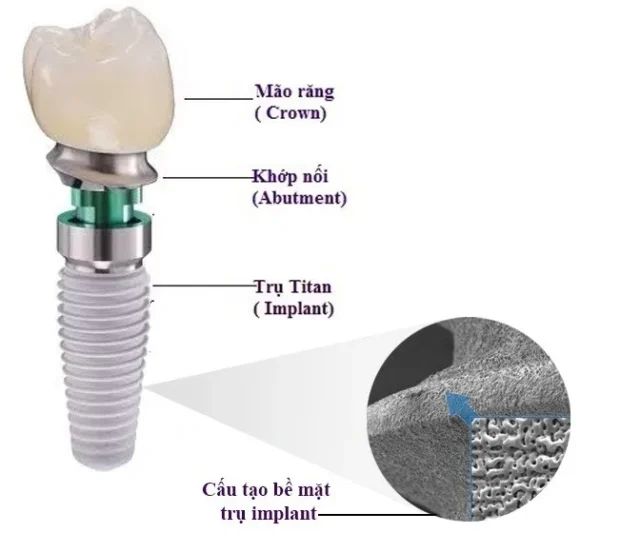 cấu tạo implant