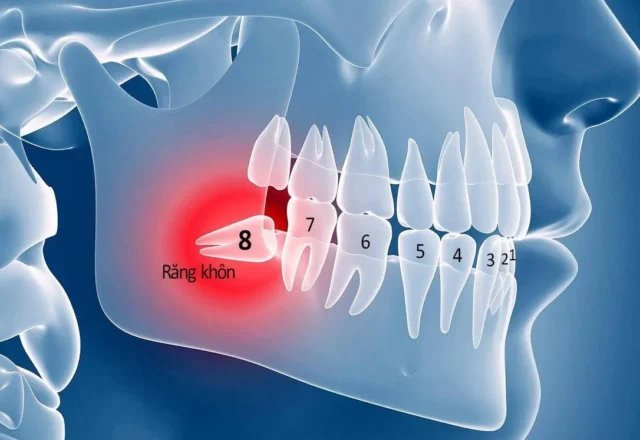 nho rang khon o dau