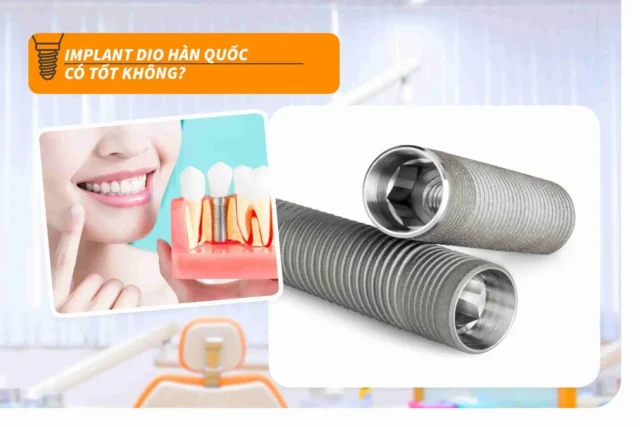 implant dio hàn quốc có tốt không