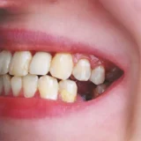 mất 1 răng