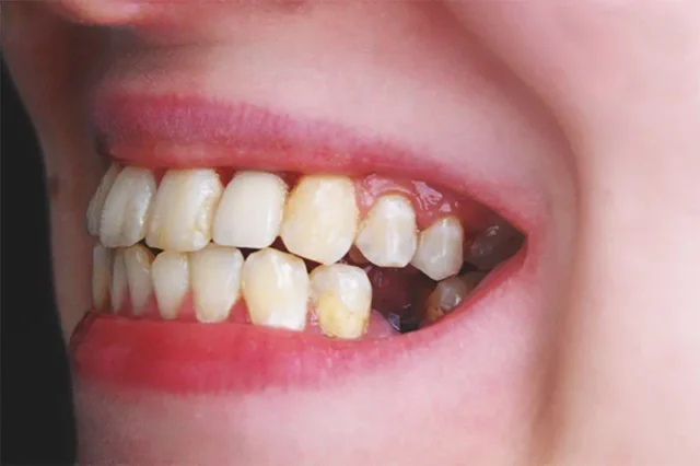 mất 1 răng