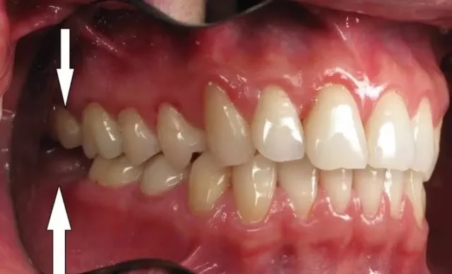mọc răng cấm có đau không