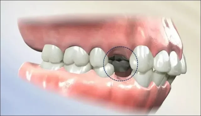 nhổ 4 răng số 4