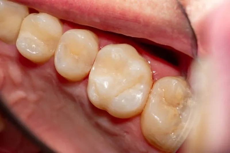 mọc răng cấm hàm dưới
