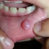nhiệt miệng nổi cục