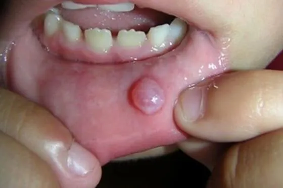 nhiệt miệng nổi cục