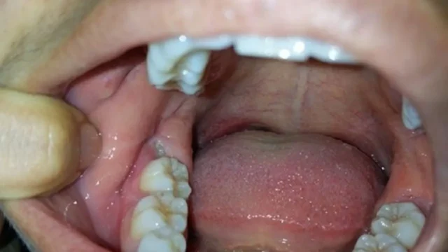mọc răng hàm dưới trong cùng