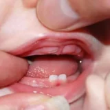 cách để răng mọc nhanh