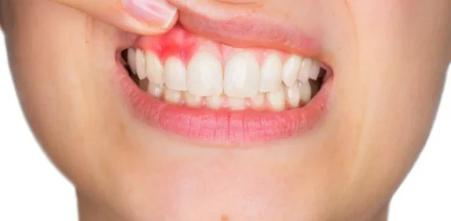 thuốc trị áp xe răng