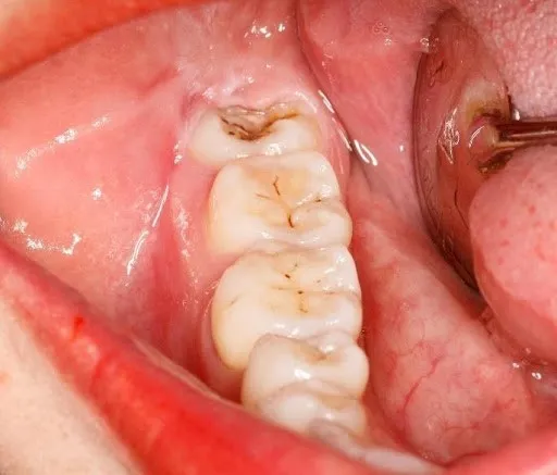 cách để răng khôn mọc thẳng