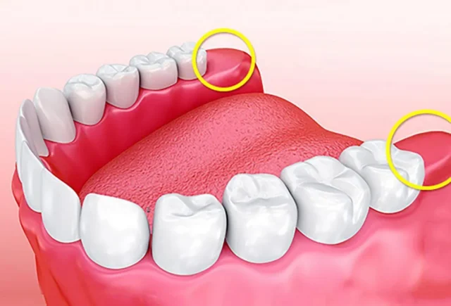 có người không mọc răng khôn