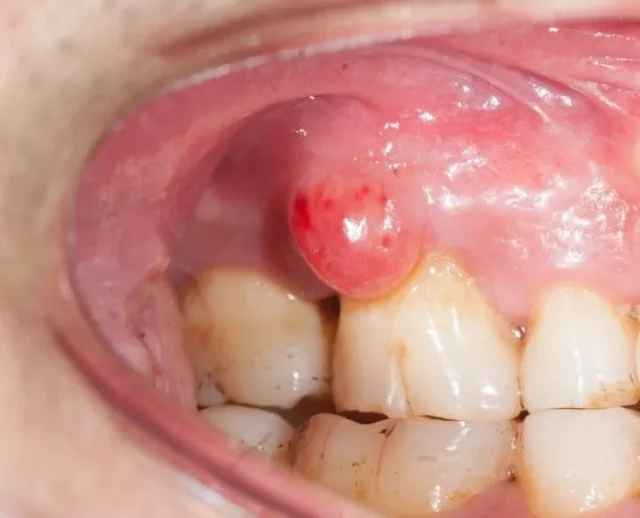áp xe nướu răng có tự khỏi không