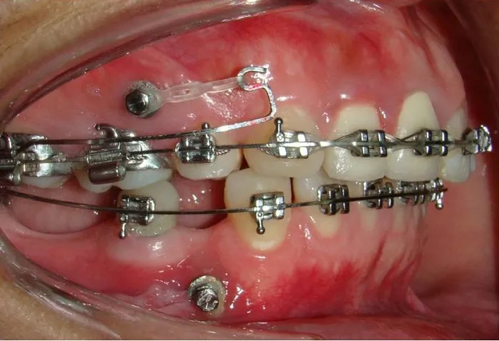 mất răng hàm có niềng răng được không