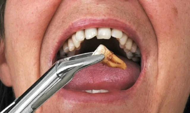 răng nào không nên nhổ