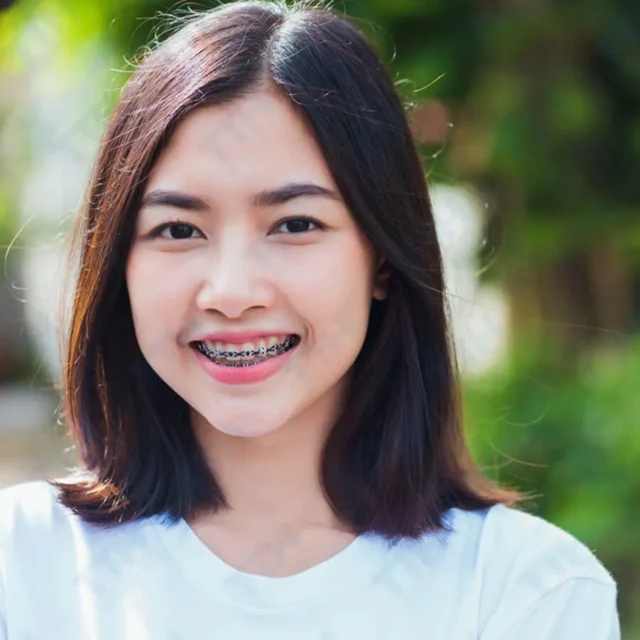 niềng răng có được dùng bảo hiểm y tế