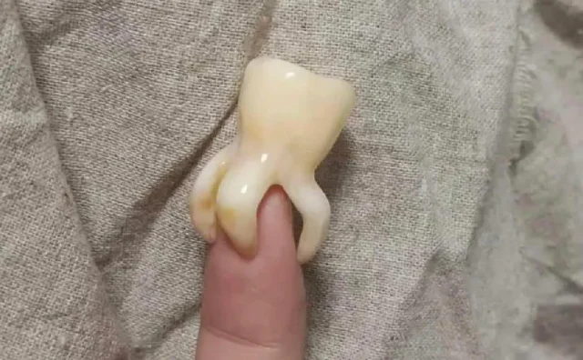 Răng khôn có mấy chân