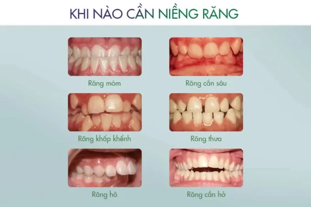 các trường hợp niềng răng